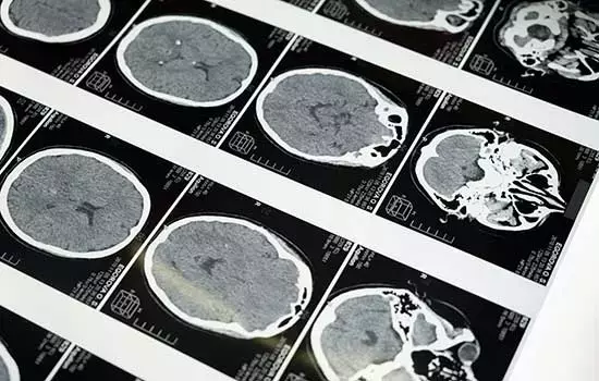 Innovador 'chip' detecta el avance del Alzheimer mediante la actividad microglial