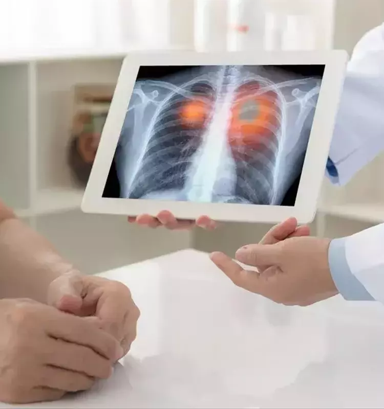Urgencia de Detección Temprana para el Cáncer de Pulmón, el Más Letal a Nivel Mundial