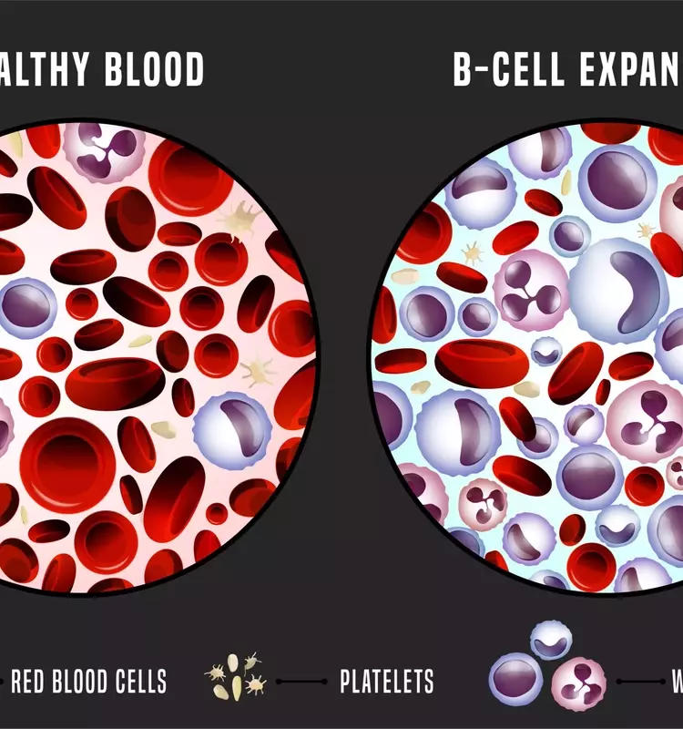 Understanding Chronic Leukemias: A Comprehensive Scientific Overview
