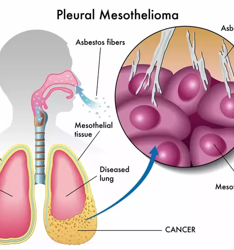 Understanding Mesothelioma: A Comprehensive Scientific Overview