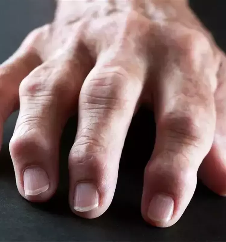 Understanding Arthritis: A Comprehensive Scientific Overview