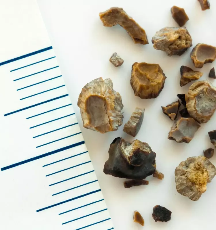 Understanding Kidney Stones: A Scientific and Technical Overview