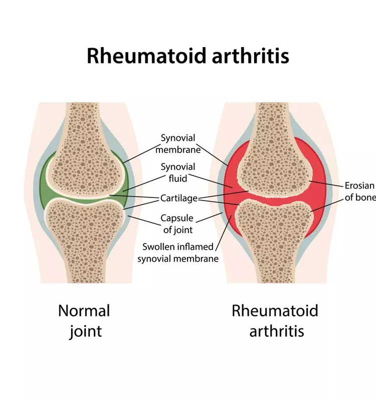 Understanding Rheumatoid Arthritis Treatment: A Comprehensive Scientific Overview