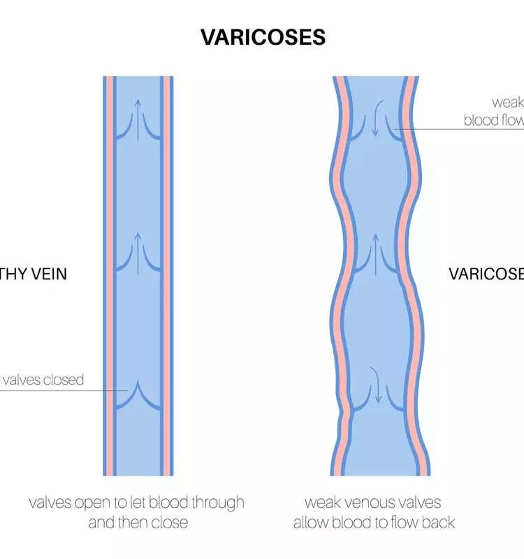 Understanding Varicose Vein Treatment: A Scientific and Technical Overview