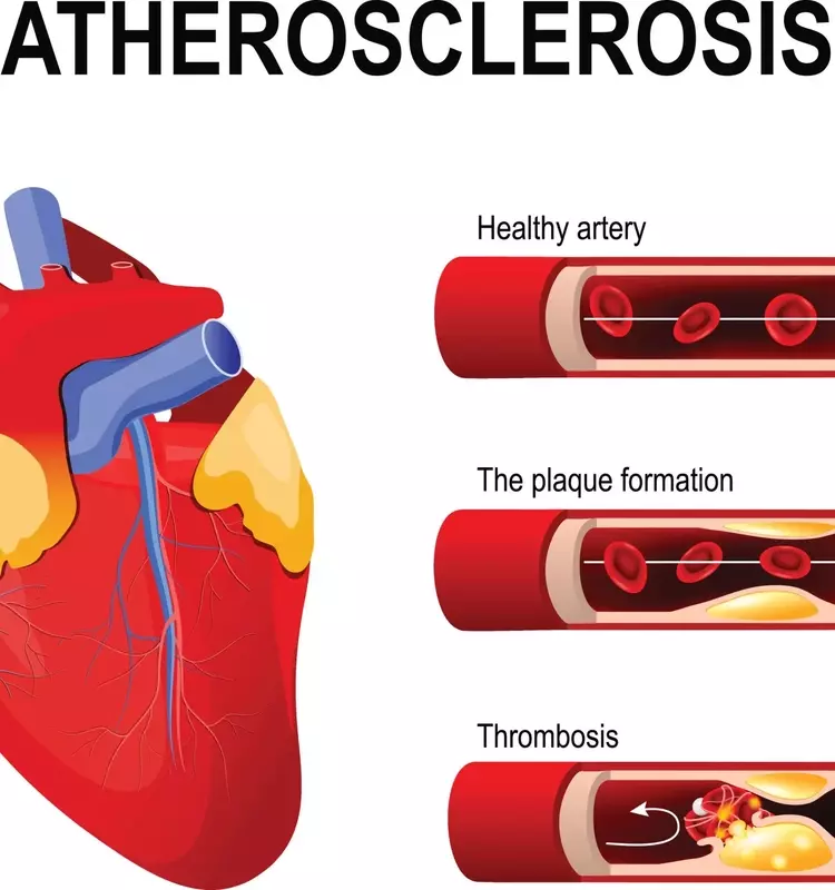 Understanding Coronary Heart Disease Treatment: A Comprehensive Clinical Overview