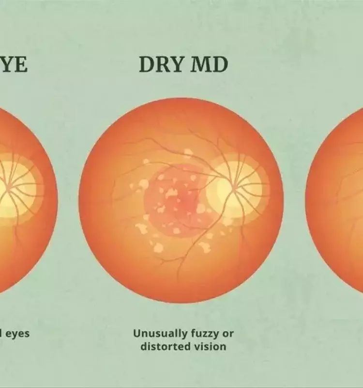 Understanding Macular Degeneration Treatment: A Comprehensive Clinical Overview