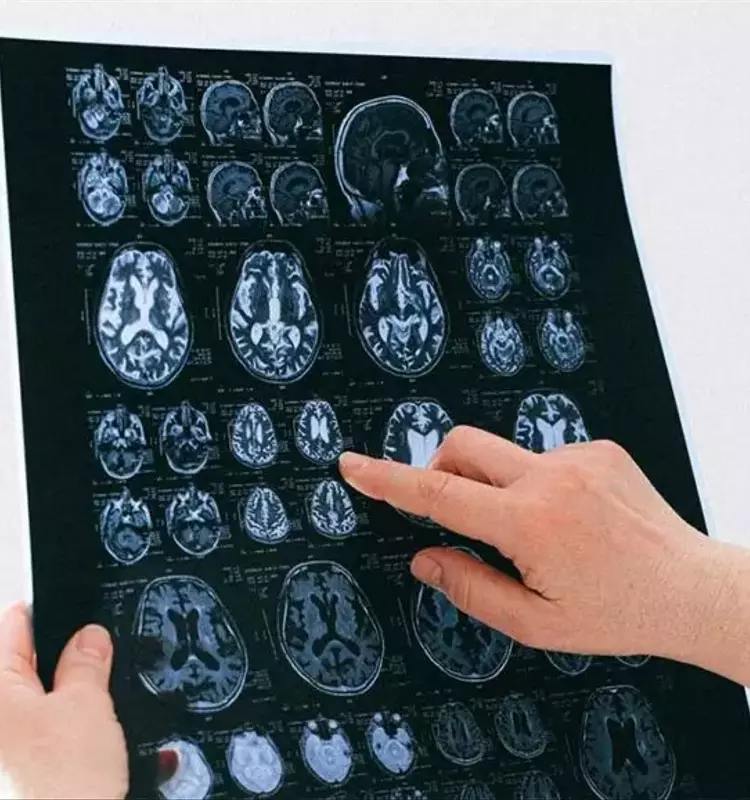 Gen APOE y Alzheimer: una conexión más fuerte de lo que se creía