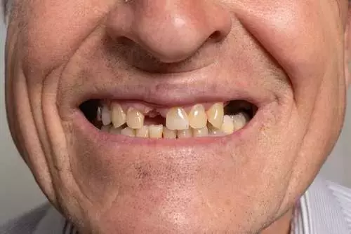 La Salud Oral es Crucial para Prevenir la Malnutrición en Adultos Mayores