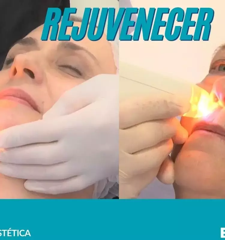Rejuvenecimiento Facial con Láser Multifrax: Innovación y Resultados