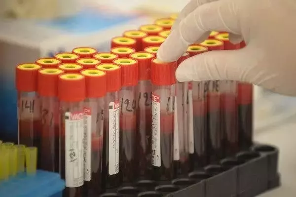 Innovador método de diagnóstico de infecciones mediante sangre seca ultracongelada