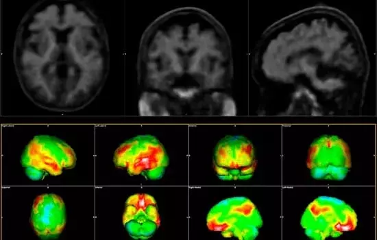 Mejorando la Detección y Tratamiento del Alzheimer a Través del Proyecto ACCESS-AD