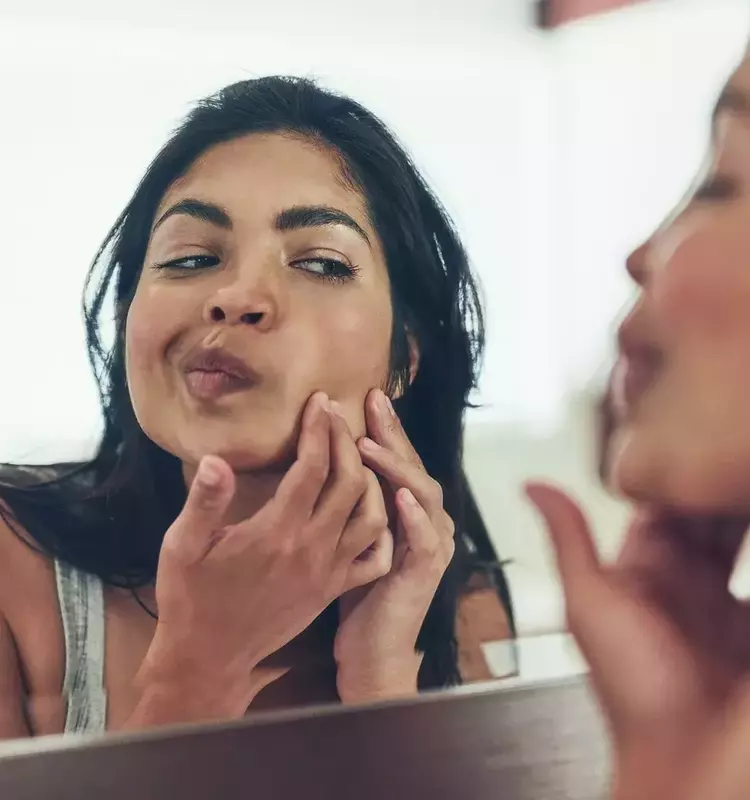 Understanding and Managing Postpartum Acne