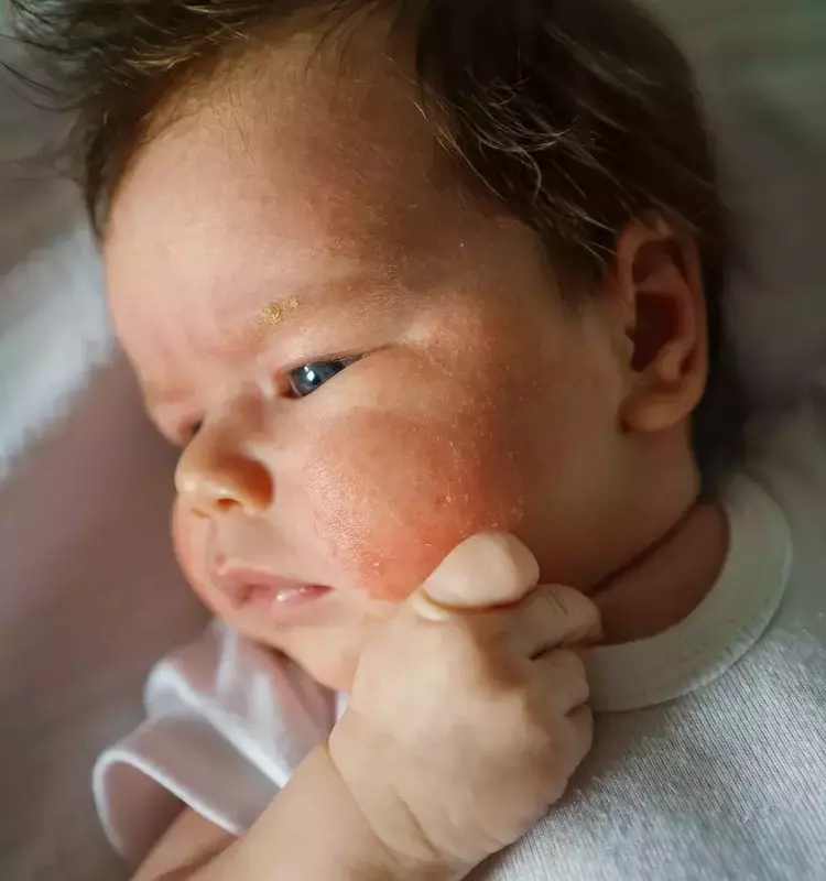 Common Rashes in Children: Identification and Management