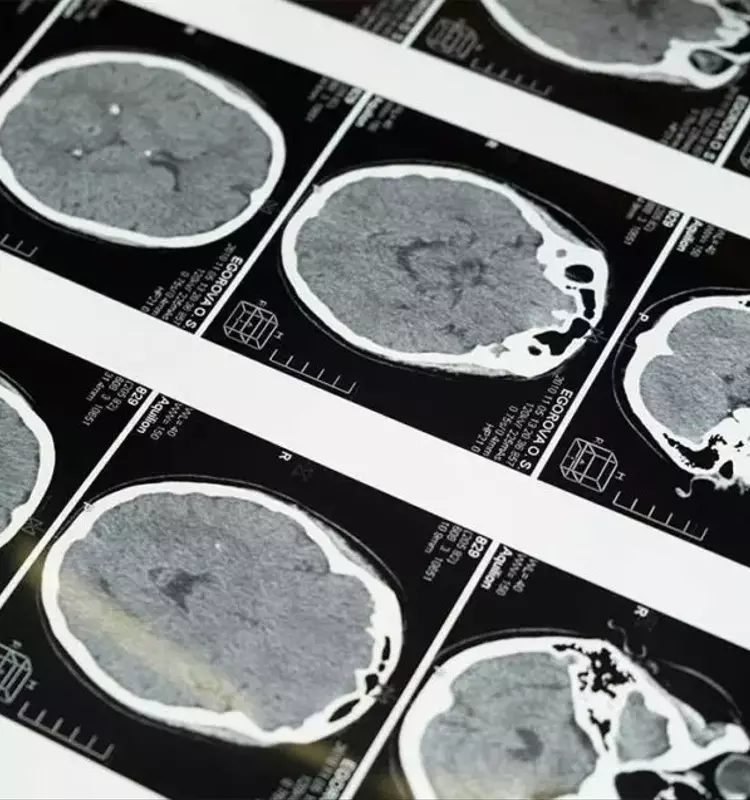 La Vitamina D y su Potencial Protector contra el Alzheimer