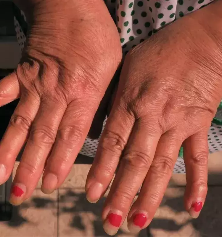 Avances prometedores: Terapia CAR-T para artritis reumatoide y síndrome de Sjögren