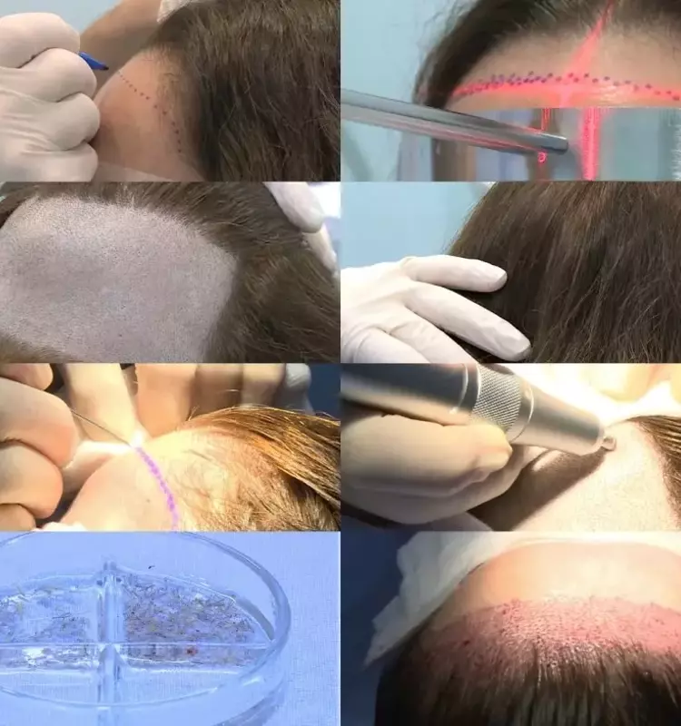 Soluciones al avance de la alopecia frontal fibrosante en mujeres: el trasplante capilar como escudo estético