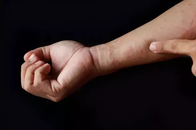 Apogee Therapeutics: Advancements in Atopic Dermatitis Treatment